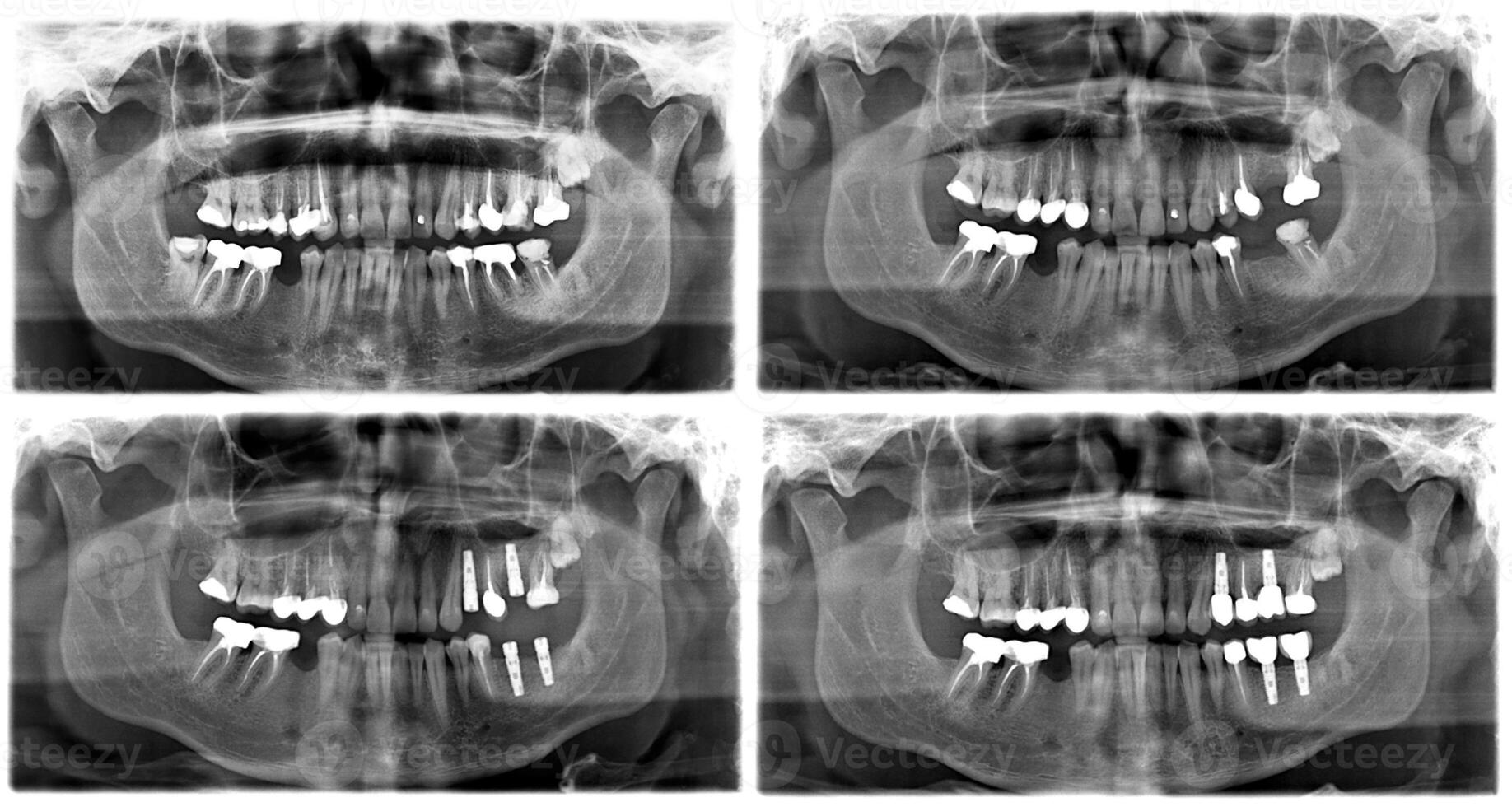 X straal van tanden foto