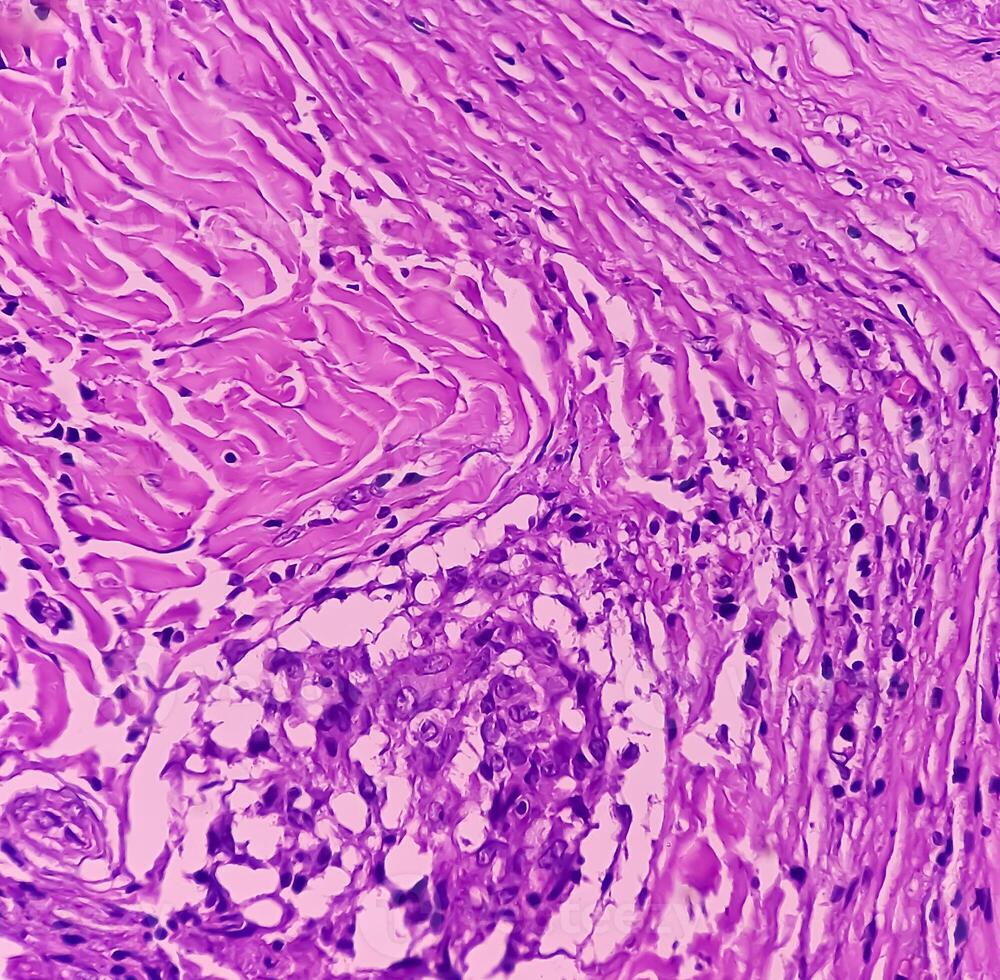 schildklier kanker. microscopisch beeld van folliculair neoplasma. kwaadaardig neoplasma van atypisch schildklier folliculair epitheliaal cellen. sommige van cellen tonen pleomorfisme met nucleair groefwerk. nodulair struma. foto