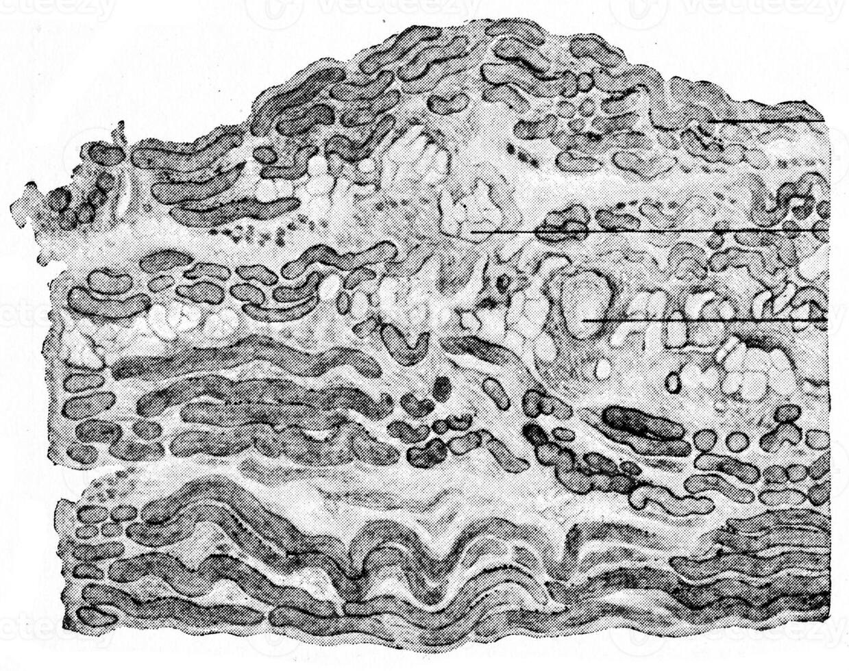 sectie genomen van de gastrocnemius spier van een kind lijden van pseudo hypertrofisch gespierd verlamming, wijnoogst gravure. foto