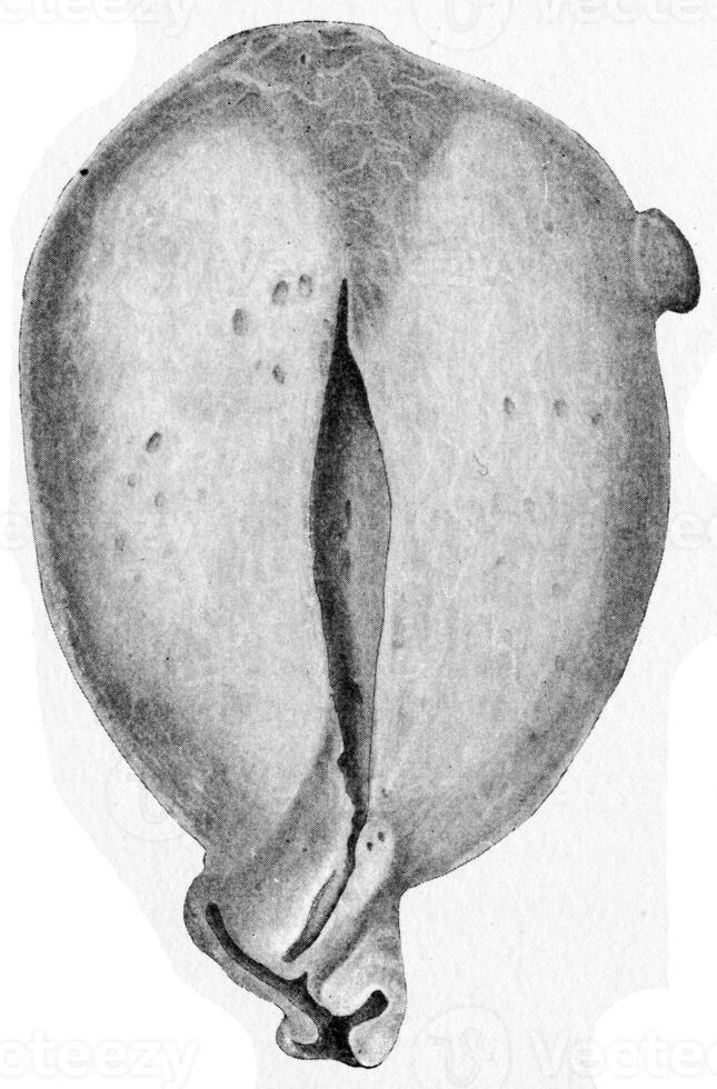 sectie van de baarmoeder tonen uniform myomateus uitbreiding, wijnoogst gravure. foto