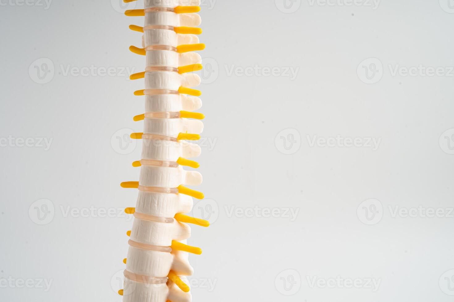 lumbaal wervelkolom verplaatst hernia schijf fragment, spinal zenuw en bot. model- voor behandeling medisch in de orthopedische afdeling. foto