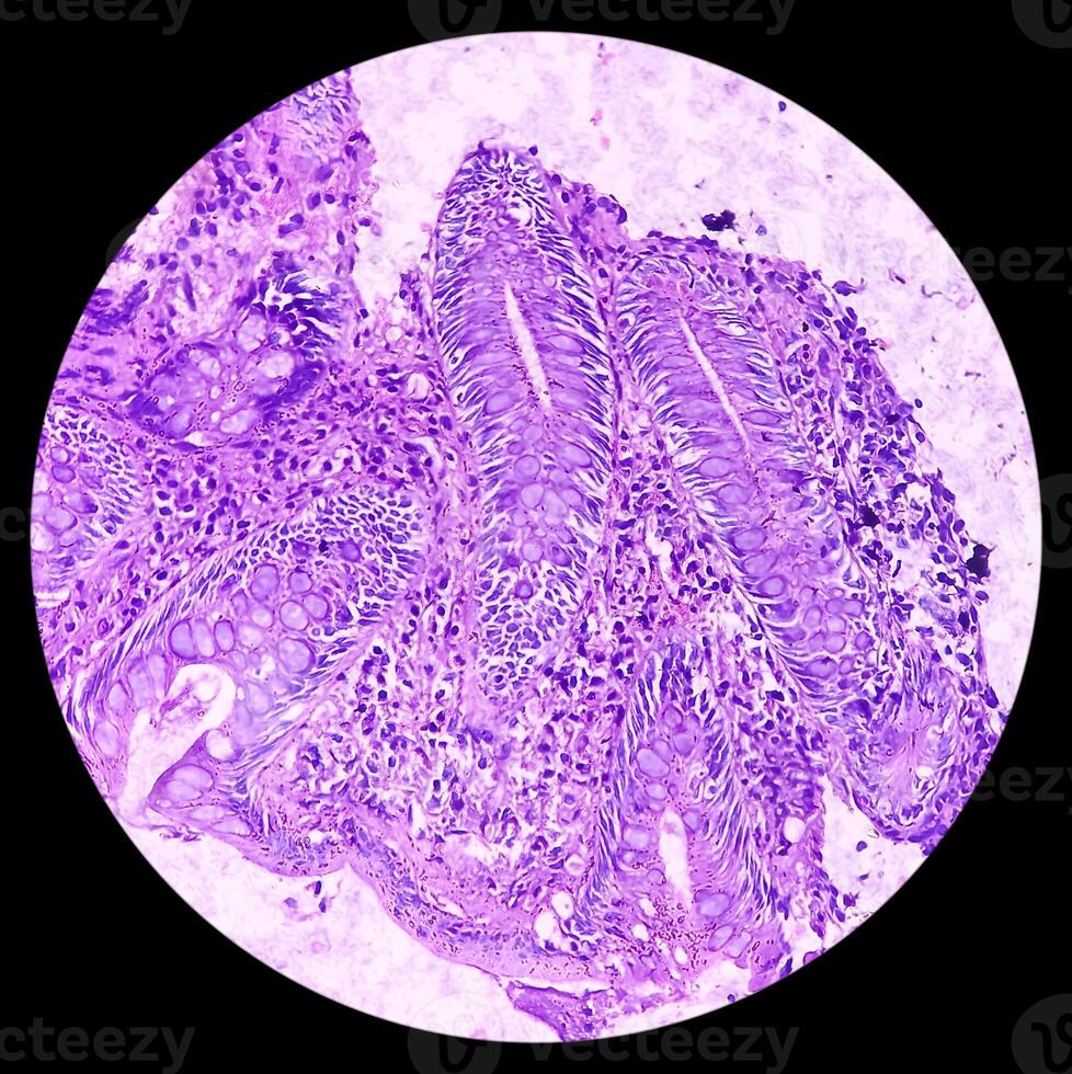 ileo-cecaal zweer. chronisch niet-specifiek ileitis met zweer. sectie tonen ileaal slijmvlies, dicht infiltratie van lymfocyten, histiocyten, plasma cel in lamina propria. idem. foto