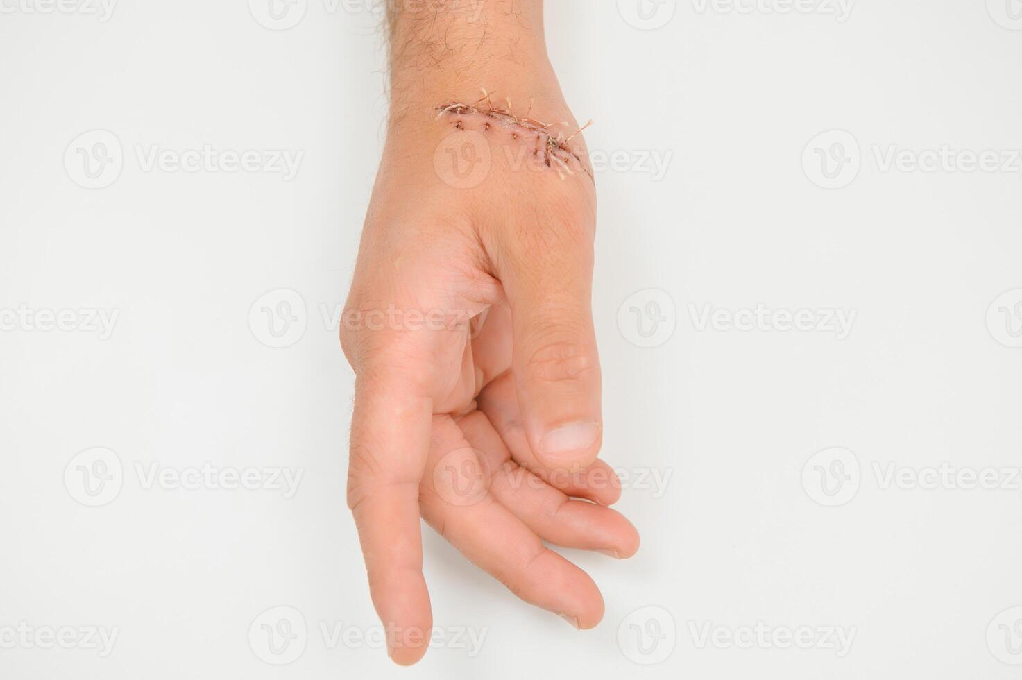 wond hand, hechten de wond. de type van besnoeiing na chirurgie. foto