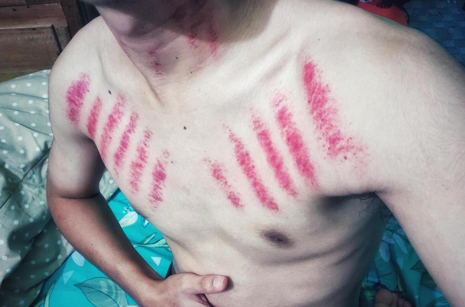 rood merken van munt krassen Aan een man's borst. kerokan is een traditioneel Javaans behandeling methode voor behandelen de symptomen van verkoudheid. deze behandeling methode is heel populair in Indonesië foto