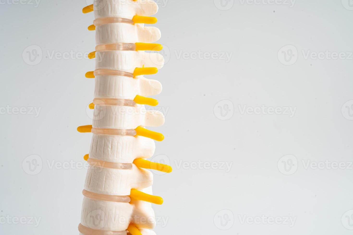 lumbaal wervelkolom verplaatst hernia schijf fragment, spinal zenuw en bot. model- voor behandeling medisch in de orthopedische afdeling. foto