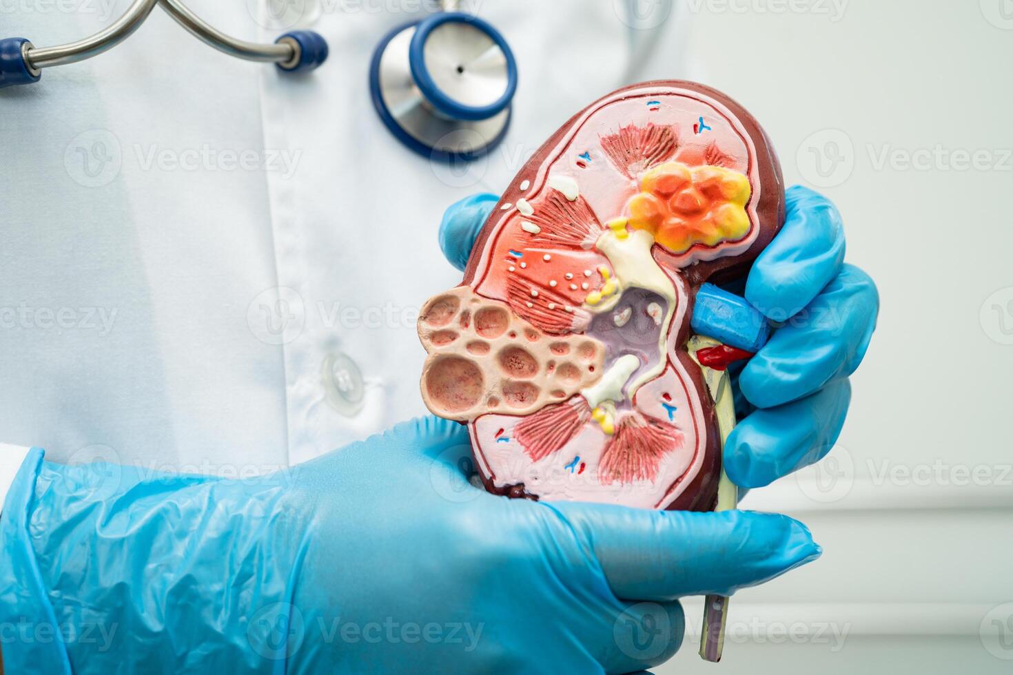 nier ziekte, chronisch nier ziekte ckd, dokter met menselijk model- naar studie en traktatie in ziekenhuis. foto