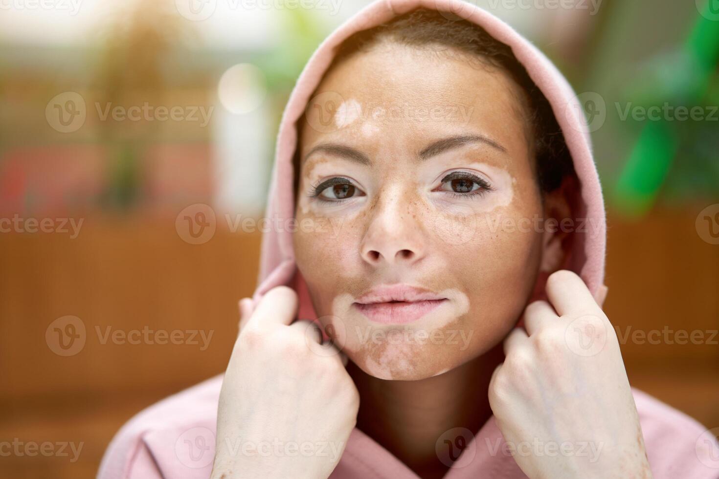 zwart Afrikaanse Amerikaans vrouw met vitiligo pigmentatie huid probleem binnen- gekleed roze capuchon foto