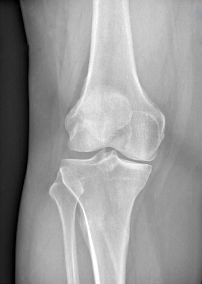 röntgenstraal van de botten van knie van een Mens. medisch concept. foto