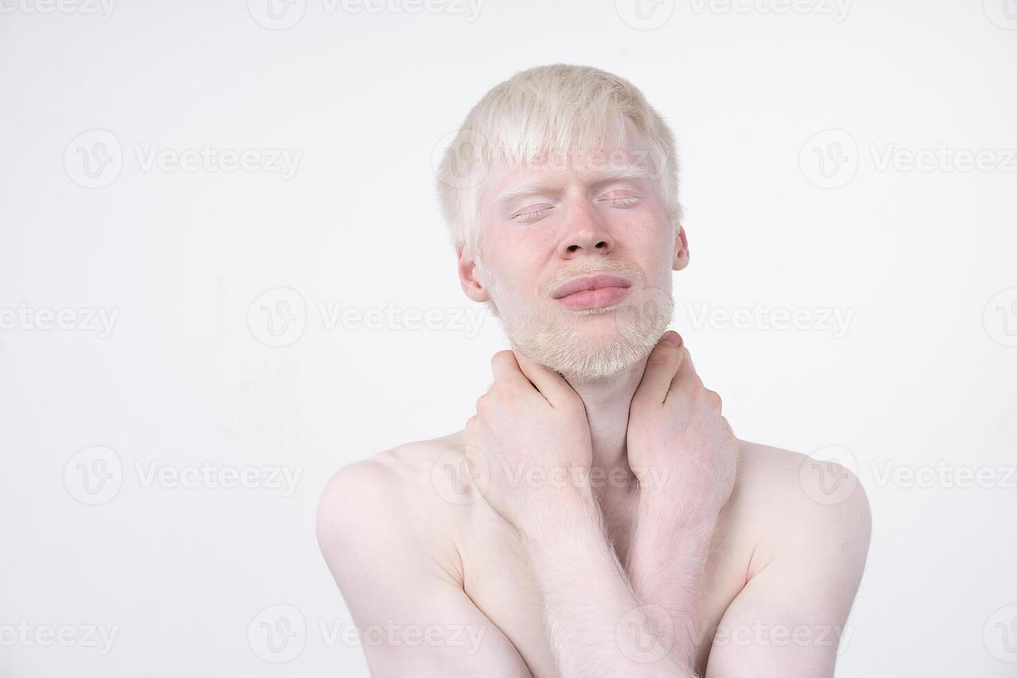 albinisme albino Mens in studio gekleed t-shirt geïsoleerd Aan een wit achtergrond. abnormaal afwijkingen. ongebruikelijk uiterlijk foto