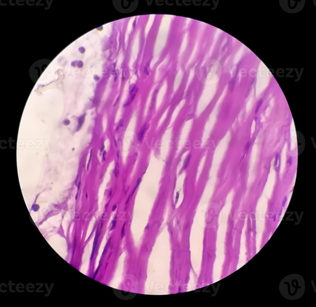 microfoto van histologisch glijbaan tonen lobulair capillair hemangioom Aan vinger. foto