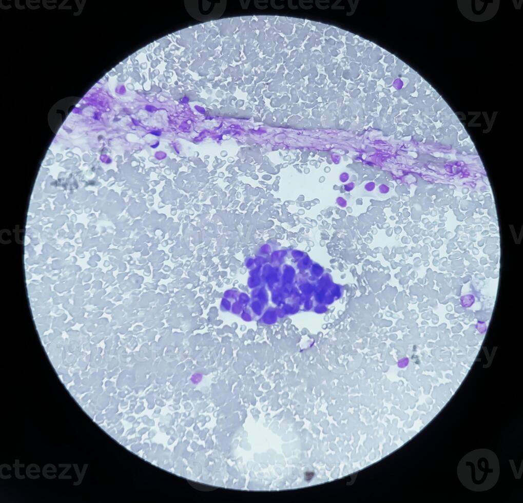 asceet vloeistof cytologie, kwaadaardig cellen, uitgezaaide adenocarcinoom foto