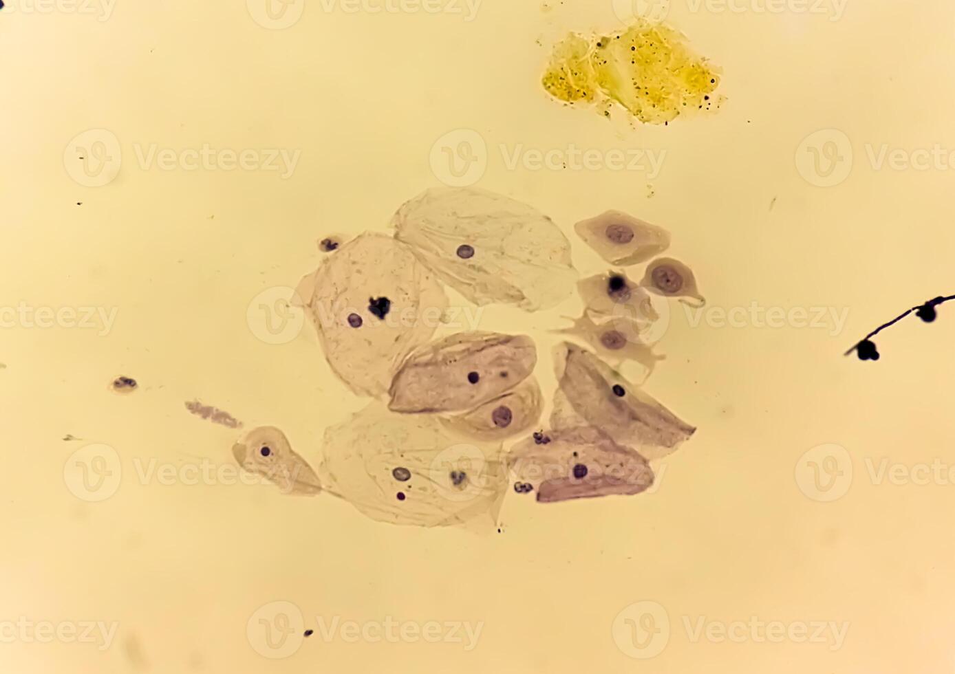 paps smeren analyse, oppervlakkig squameus cel, metaplastisch squameus cel, koilocyten cel. hpv verwant verandering foto