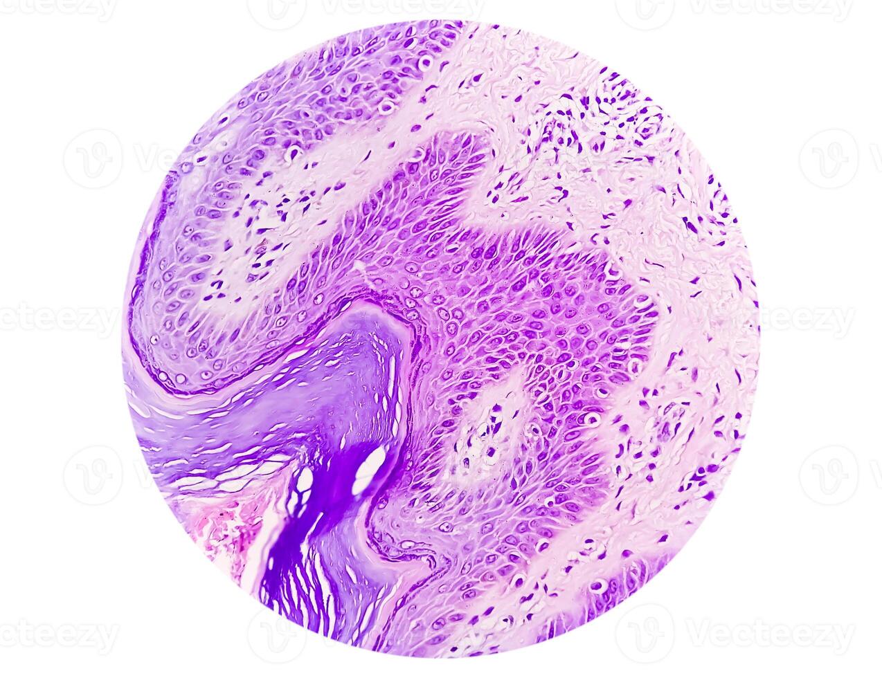 histologisch microfoto. prurigo nodularis of pn is een chronisch wanorde van de huid. foto