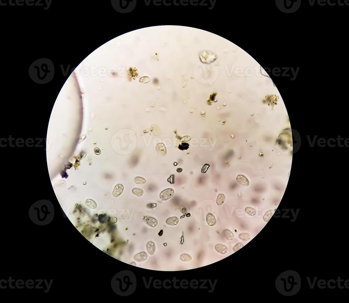 schistosoom parasiet eicellen in menselijk urine exemplaar onder microscoop. urine- parasiet foto