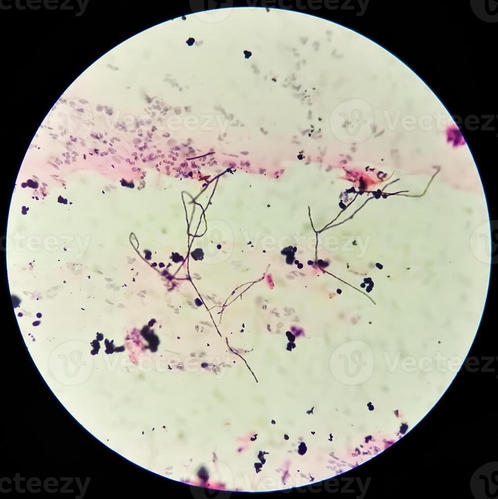 microfoto van paps smeren. opruiend smeren met vaginaal candidiasis . medisch concept. foto