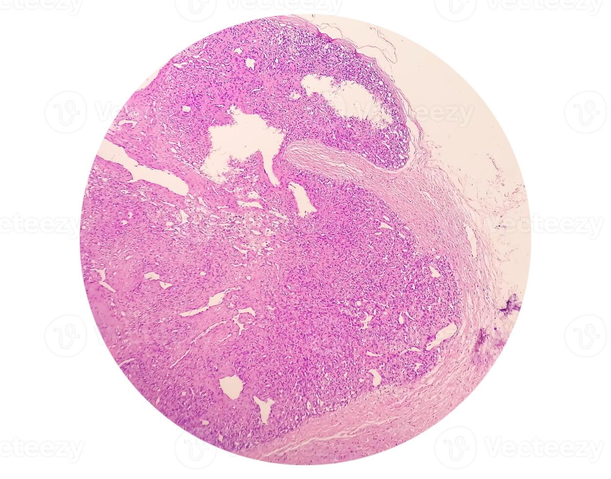 histologisch microfoto. prurigo nodularis of pn is een chronisch wanorde van de huid. foto