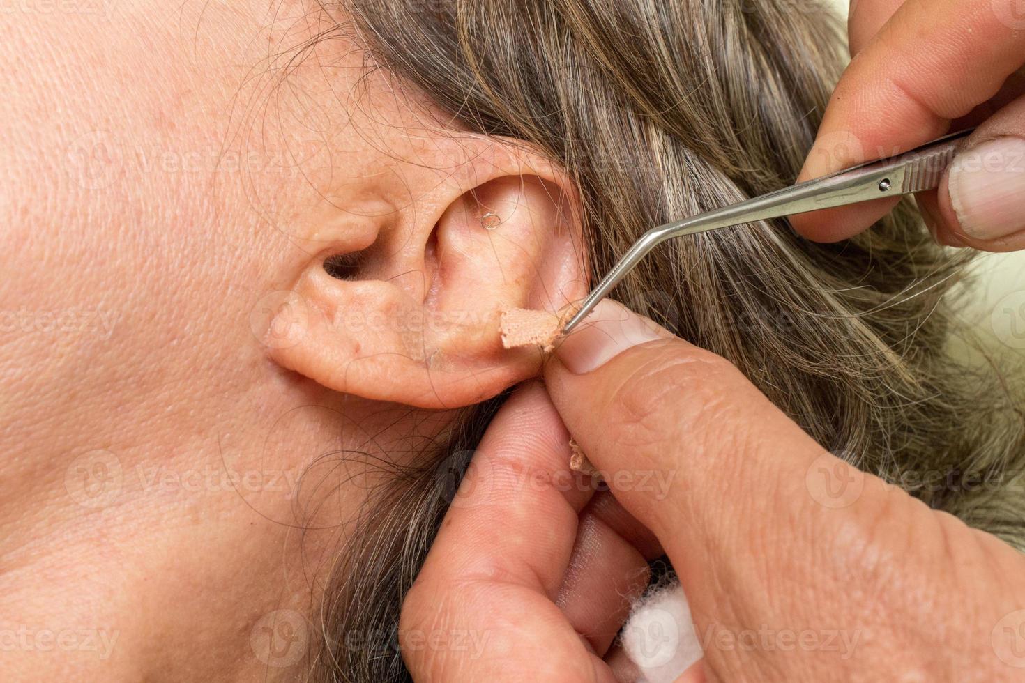 vrouw die een ooracupunctuurbehandeling heeft ondergaan waarbij de oorstekers zijn verwijderd foto