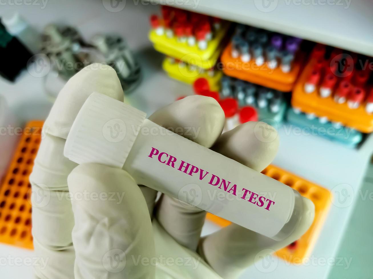 wetenschapper met monstercontainer met baarmoederhalsvloeistofmonster voor pcr hpv dna-test, humaan papillomavirus, baarmoederhalskanker. een medisch testconcept in het laboratorium foto