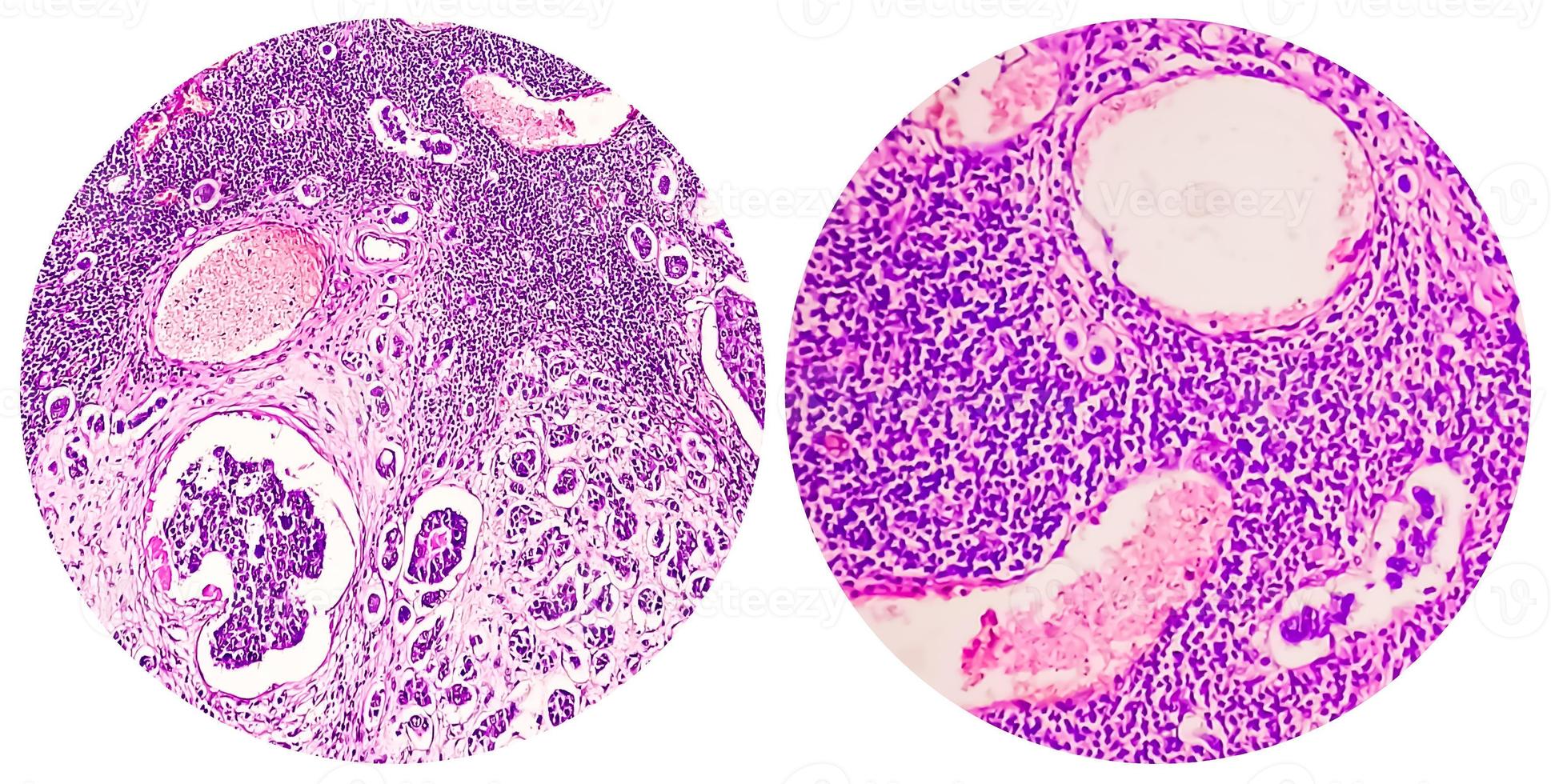 college van twee microfoto met invasief ductaal carcinoom foto