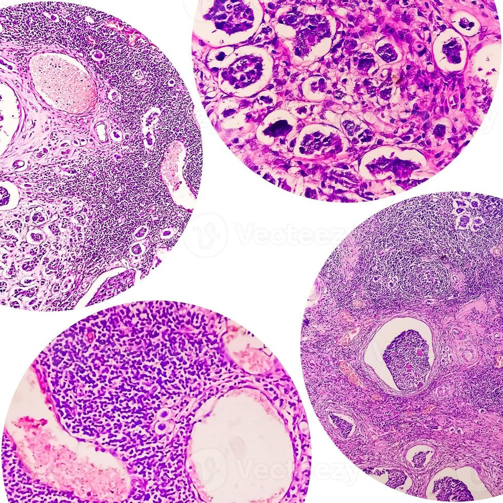 college van vier microscoopfoto met invasief ductaal carcinoom foto