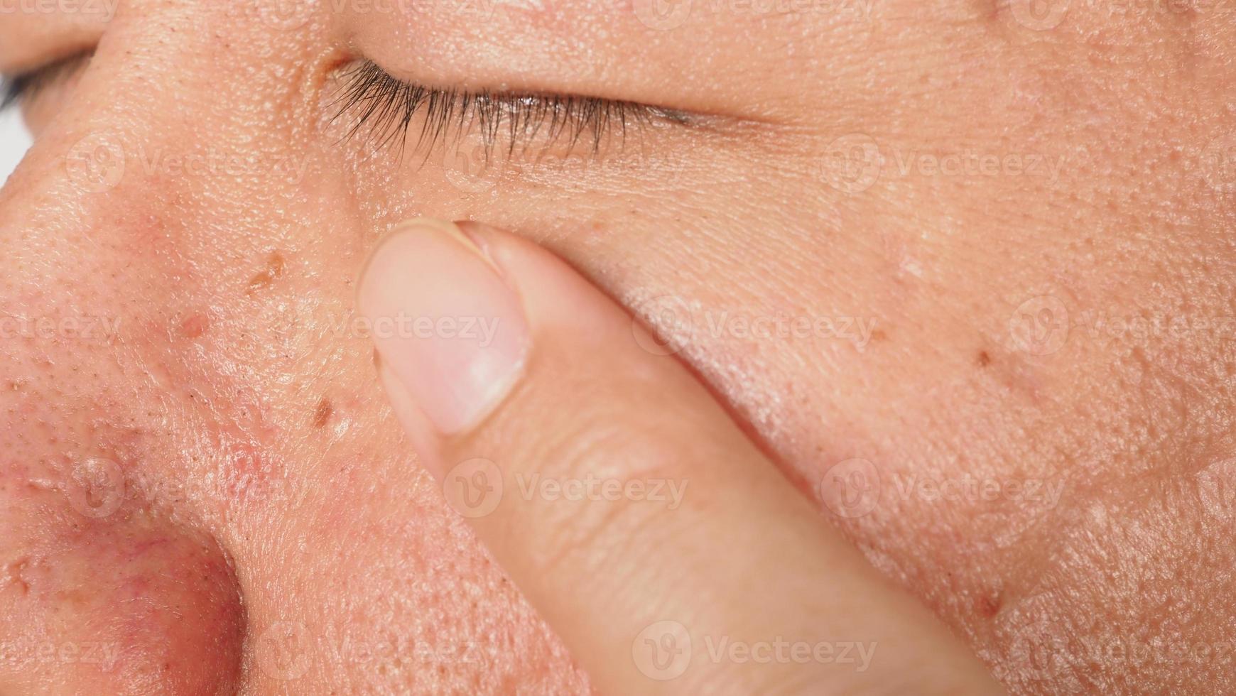 wrat op het gezicht. macro-opname van wrat in de buurt van oog. papilloma op de huid. foto