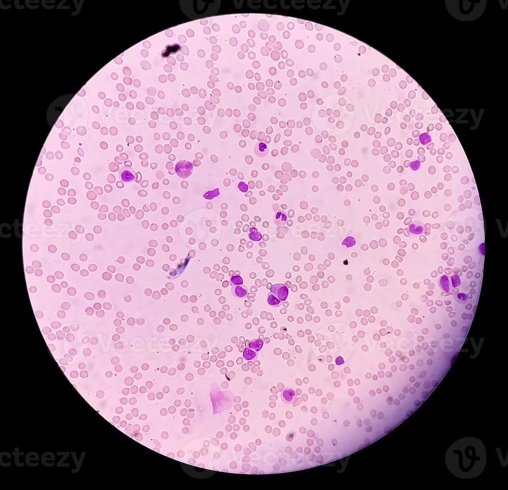 microscopisch beeld van acute myeloïde leukemie, myeloblastische leukemie, een kanker van witte bloedcellen. 10x foto