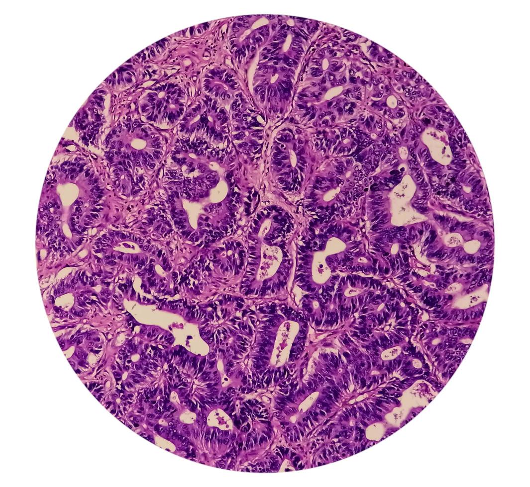 adenocarcinoom. microfoto. histologie. microscopisch glaasje. 40x foto