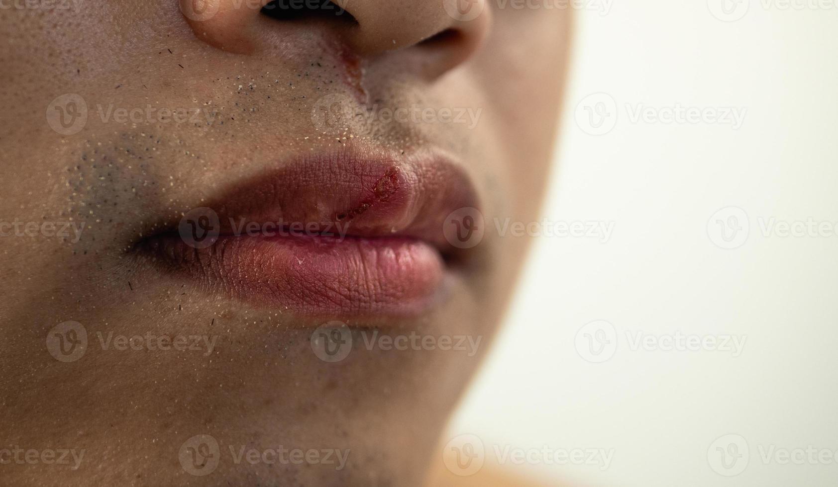 gebarsten lippen van de mens in het winterseizoen. Close-up shot. deze mannenhuid is in Aziatische stijl. foto