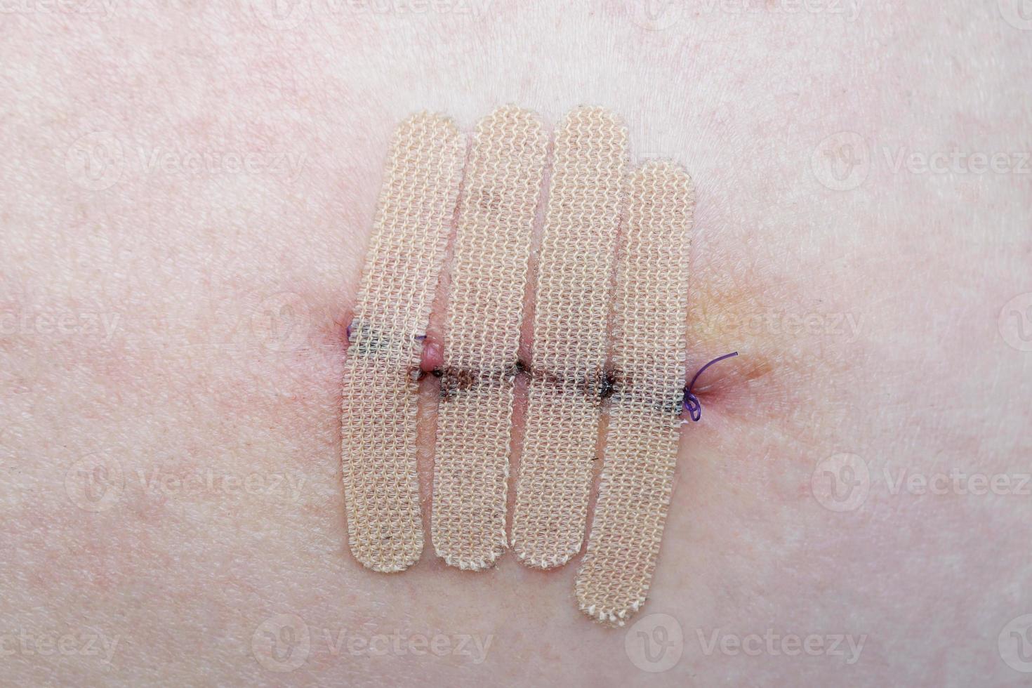 huid met hechtdraad en wondsluitstrips of chirurgische tape foto