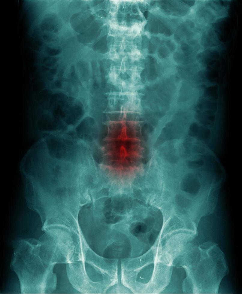 röntgenfoto van de buik toont lumbale spondylose foto