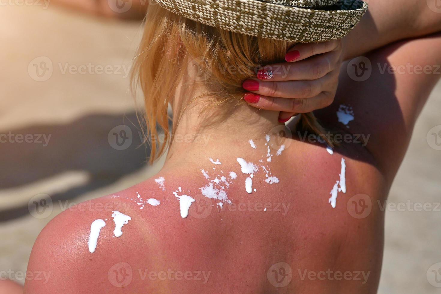 vrouw wrijft zonnebrandcrème op zijn schouder. tegen de achtergrond van de zee. foto
