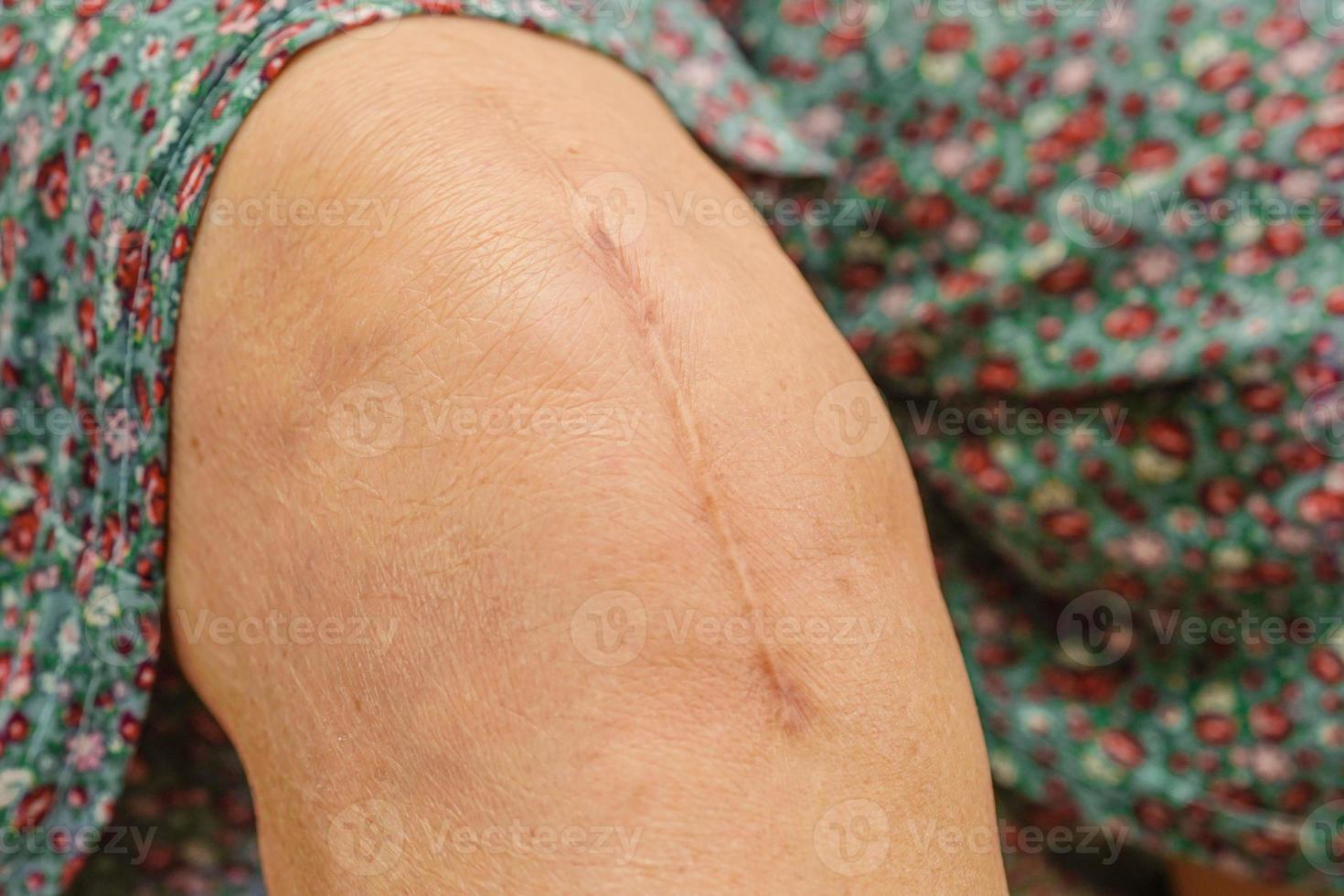 Aziatische oudere vrouw patiënt met litteken knie vervangende operatie in het ziekenhuis. foto