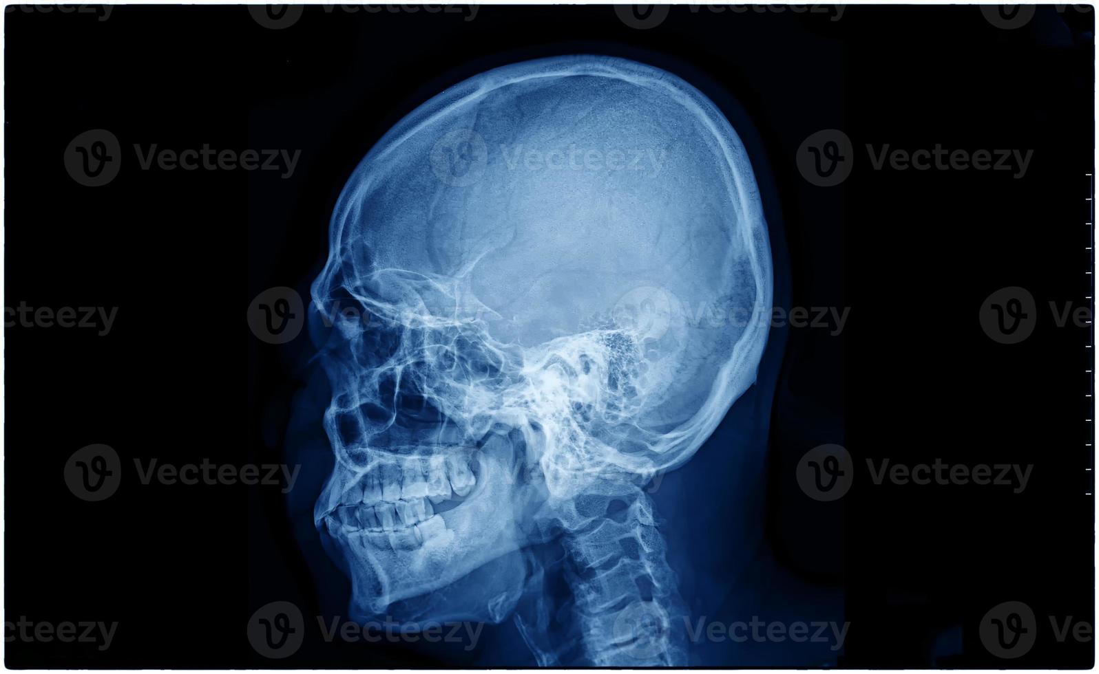 film x-ray schedel en cervicale wervelkolom zijaanzicht voor medisch concept. foto