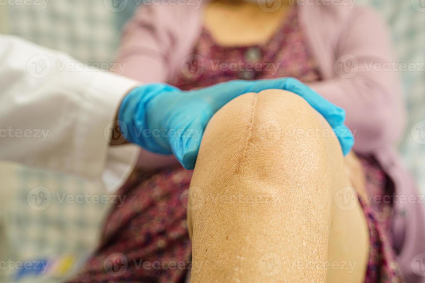 Aziatische oudere vrouw patiënt met litteken knie vervangende operatie in het ziekenhuis. foto