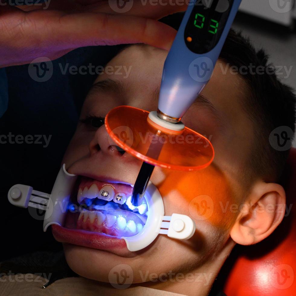 uitlijning van scheve tanden met behulp van beugels, installatie van beugels voor een kind, een orthodontist lijmt metalen platen beugels voor het uitlijnen van tanden. foto