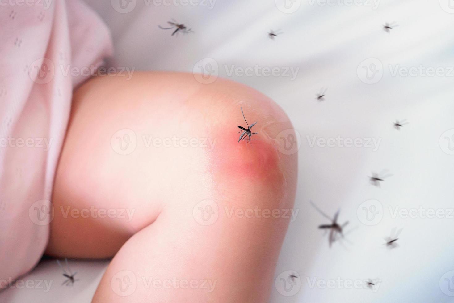 schattig Aziatisch babymeisje heeft uitslag en allergie op de kniehuid door muggenbeet en bloedzuigen foto