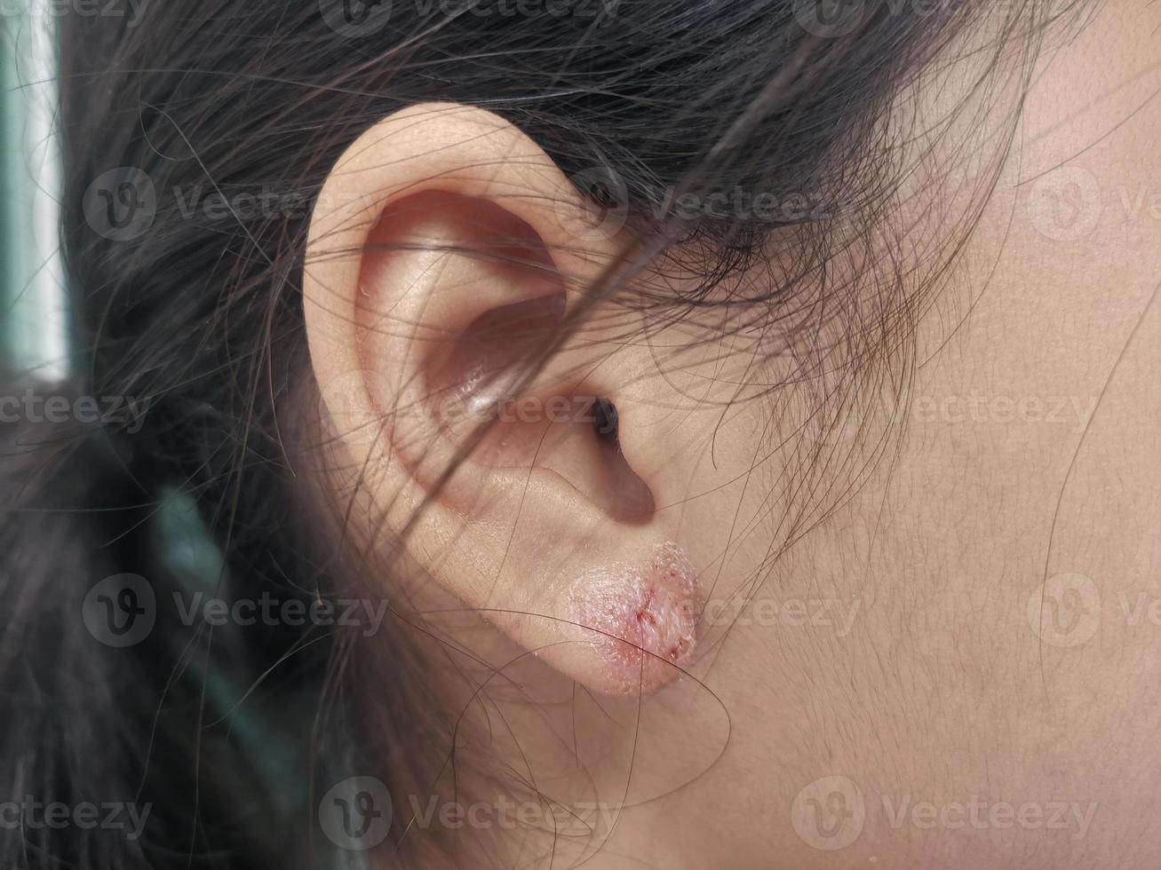 close-up van een oorwond veroorzaakt door piercing oren foto