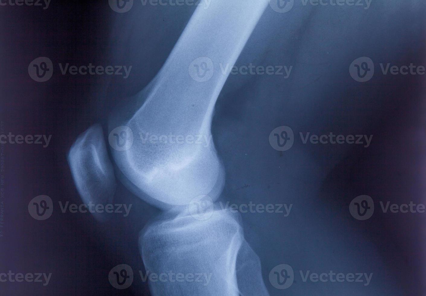 enkelvoeten en kniegewrichtspijn röntgenfoto mri-fotofilm foto