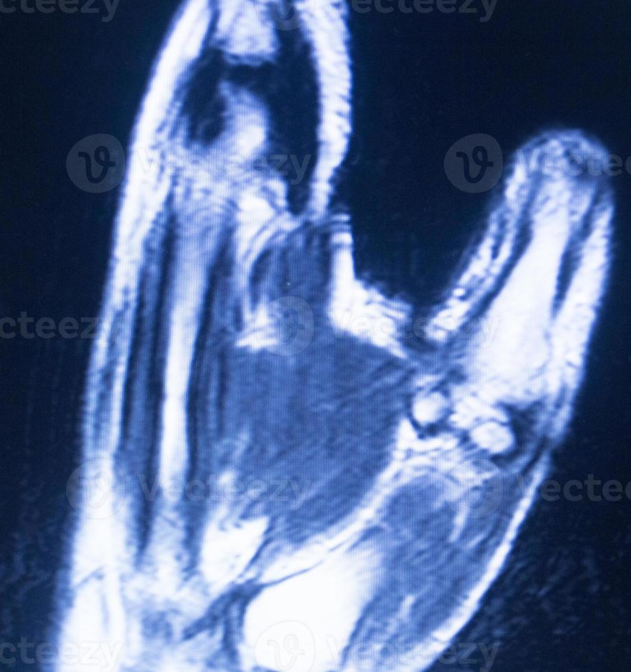 mri magnetische resonantie beeldvorming hand carpaal scan foto