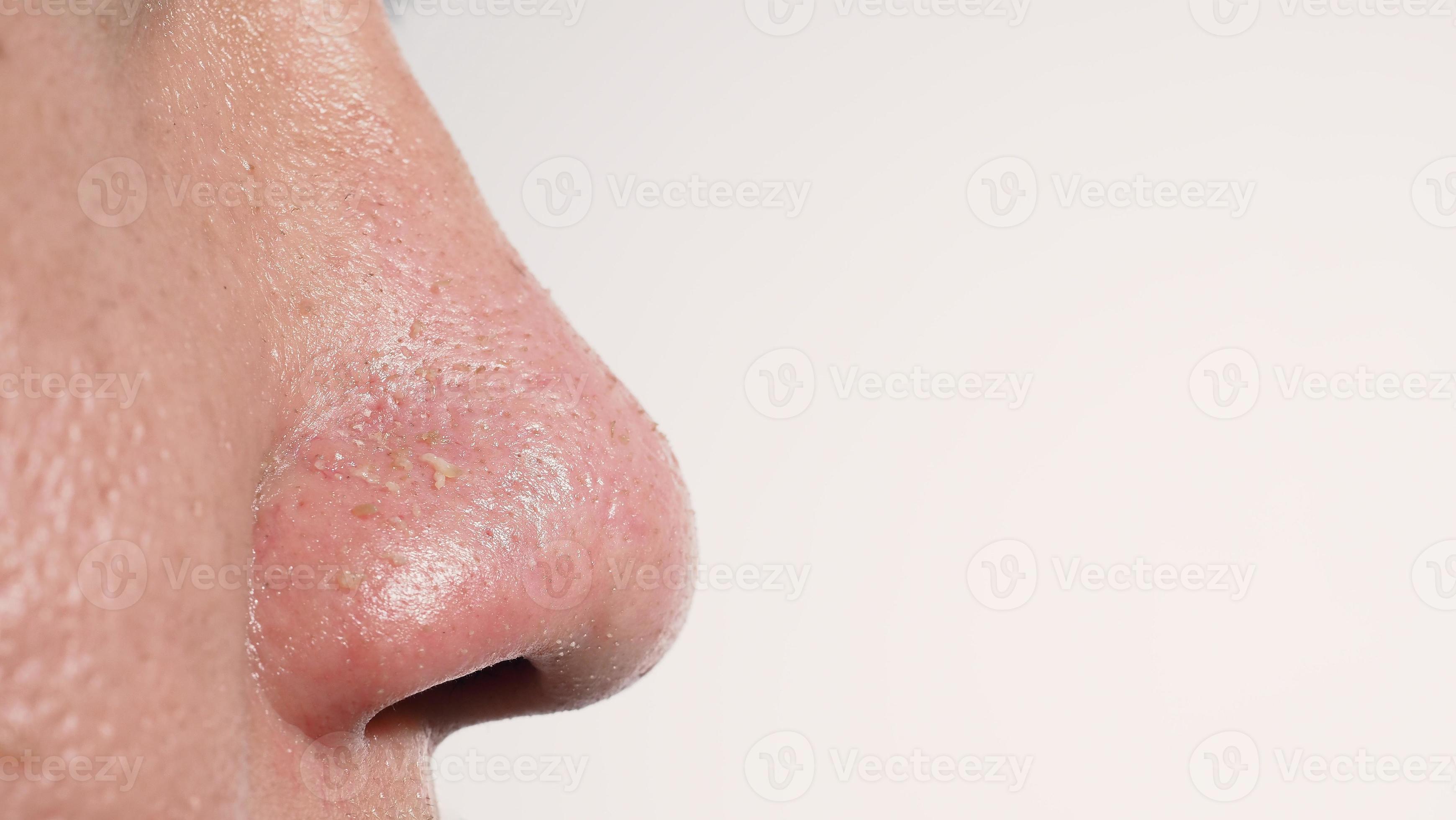 Peer geschenk Inspecteur acne en probleem poriën. wit en mee-eter puistjes van neus- poriën.  11704817 Stockfoto