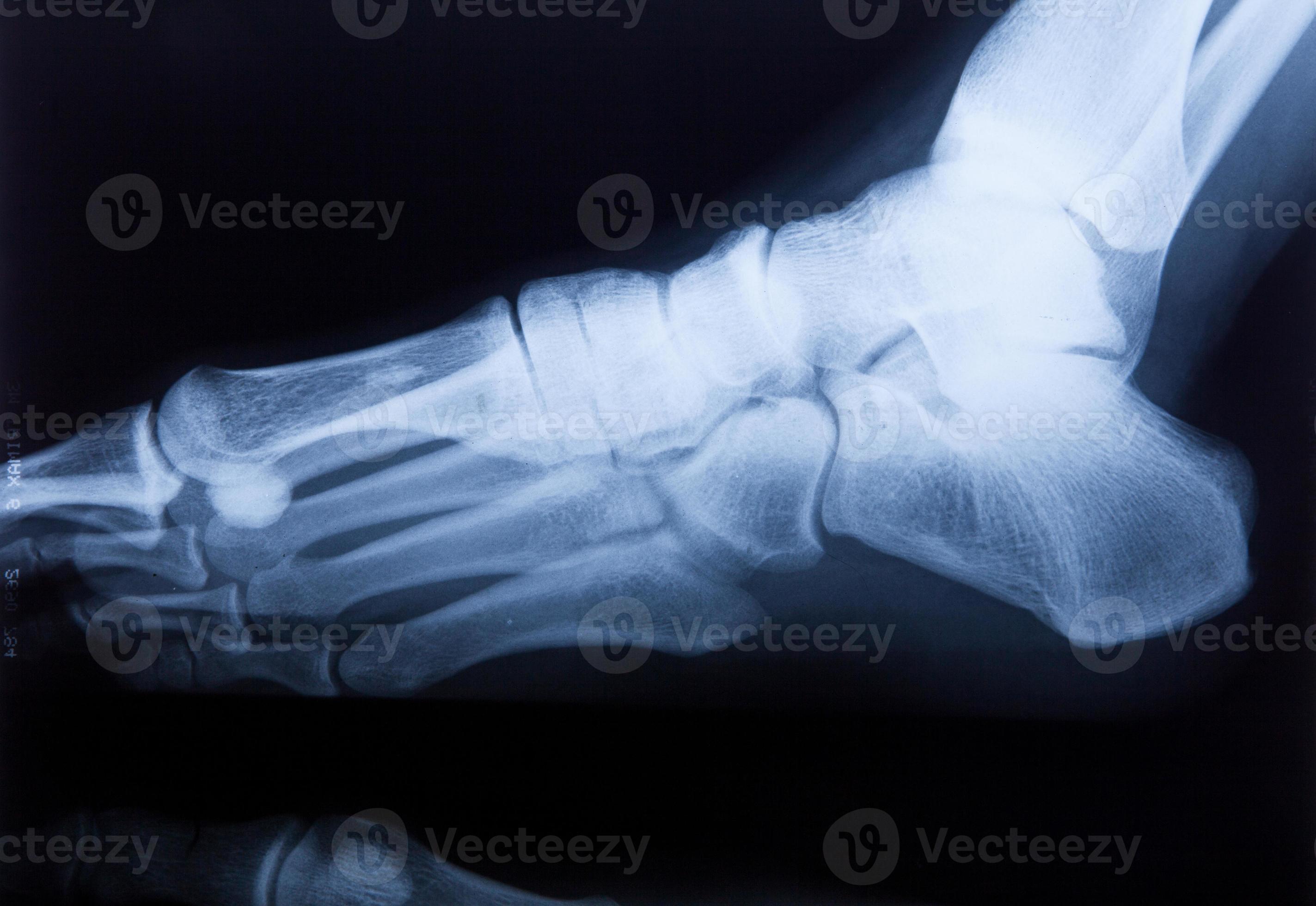 enkelvoeten en kniegewrichtspijn menselijke x-ray mri-film foto