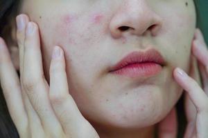 acne puistje en litteken op de huid gezicht, aandoeningen van de talgklieren, tienermeisje huidverzorging schoonheidsprobleem. foto