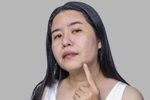 close-up van het gezicht van een Aziatische volwassen vrouw heeft sproeten, grote poriën, mee-eter puistje en littekens probleem van niet verzorgen voor een lange tijd. zachte focus van huidprobleem gezicht. behandeling en huidverzorging concept foto