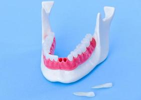 tand implantaat en kroon installatie werkwijze foto