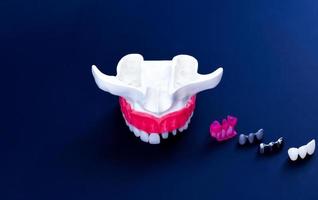 tand implantaat en kroon installatie werkwijze foto