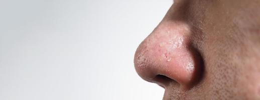 acne en probleem poriën. wit en mee-eter puistjes van neus- poriën. foto