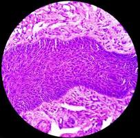 huid biopsie, suggestief van basaal cel carcinoom, de meest gemeenschappelijk type van huid kanker. foto
