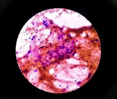 cytologisch studie van intra buik massa, spil cel sarcoom, positief voor kwaadaardig cellen. pleomorf ongedifferentieerd sarcoom, kwaadaardig vezelig histiocytoom. foto