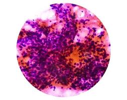 cytologisch studie van intra buik massa, spil cel sarcoom, positief voor kwaadaardig cellen. pleomorf ongedifferentieerd sarcoom, kwaadaardig vezelig histiocytoom. foto