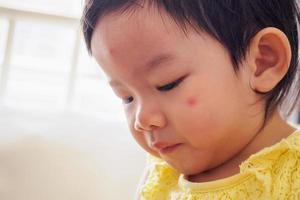 schattig weinig Aziatisch meisje met allergie rood plek gezicht oorzaak door insect beet foto